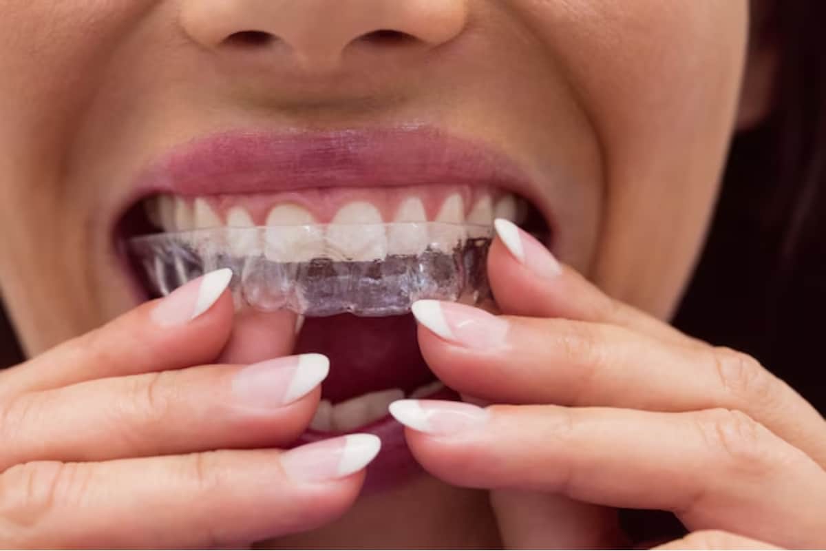 Unlocking the Secret to Tracking Progress with Invisalign in Norfolk: A Comprehensive Guide
